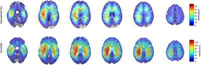 Topographical Mapping of 436 Newly Diagnosed IDH Wildtype Glioblastoma With vs. Without MGMT Promoter Methylation